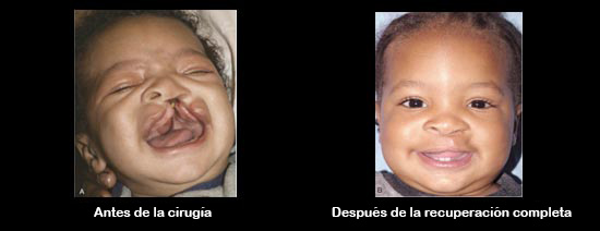 https://babdex.store/SiteCollectionImagesArticleImages/CleftbeforeAfter_Baby_es.jpg