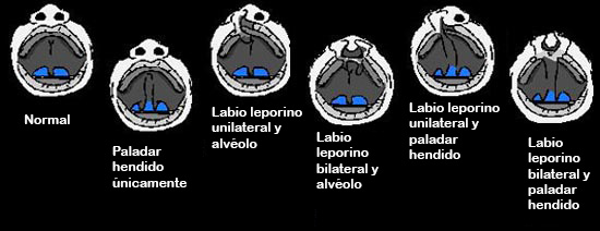https://babdex.store/SiteCollectionImagesArticleImages/CleftlippalateABCDEF_es.jpg