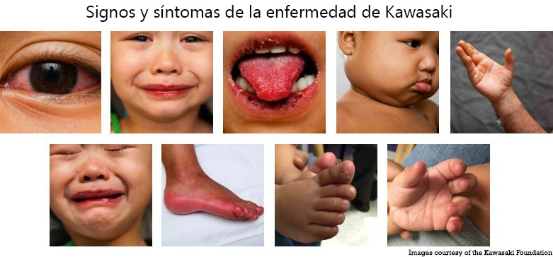 https://babdex.store/SiteCollectionImagesArticleImages/Signs_Symptoms_Kawasaki_Disease_es.jpg