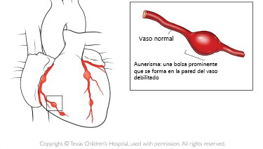 https://babdex.store/SiteCollectionImagesArticleImages/aneurysm_texaschildrens_es.jpg