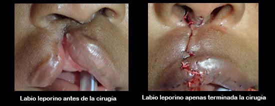 https://babdex.store/SiteCollectionImagesArticleImages/cleftLipBeforeAfter2_es.jpg